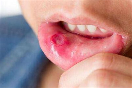 满嘴口腔溃疡？是上火了吗？也许还是口腔癌警报